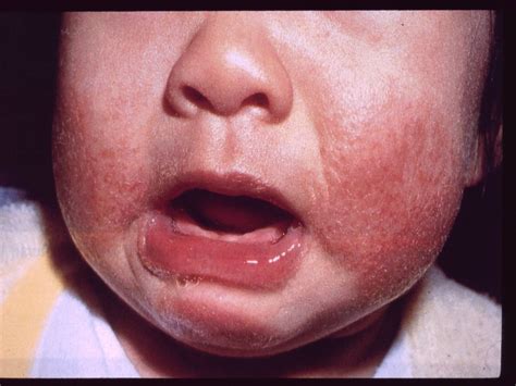 What Causes Severe Eczema In Babies